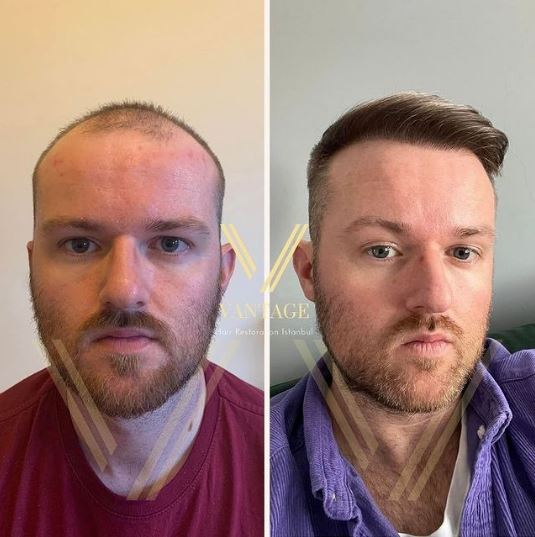 Пересадка светлых волос до и после: результат в Турции