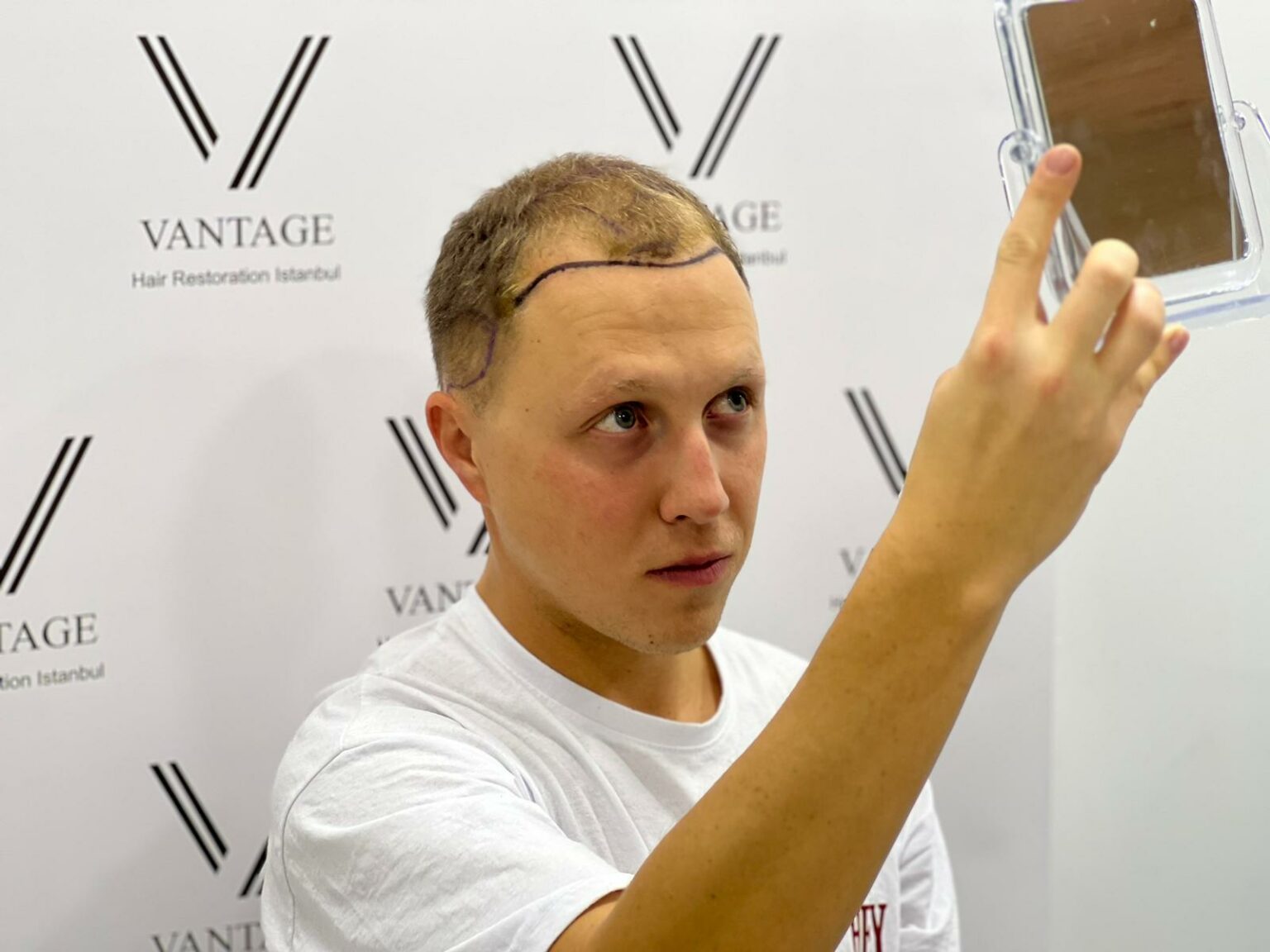 Клиника по пересадке волос в Стамбуле Vantage Hair Restoration 