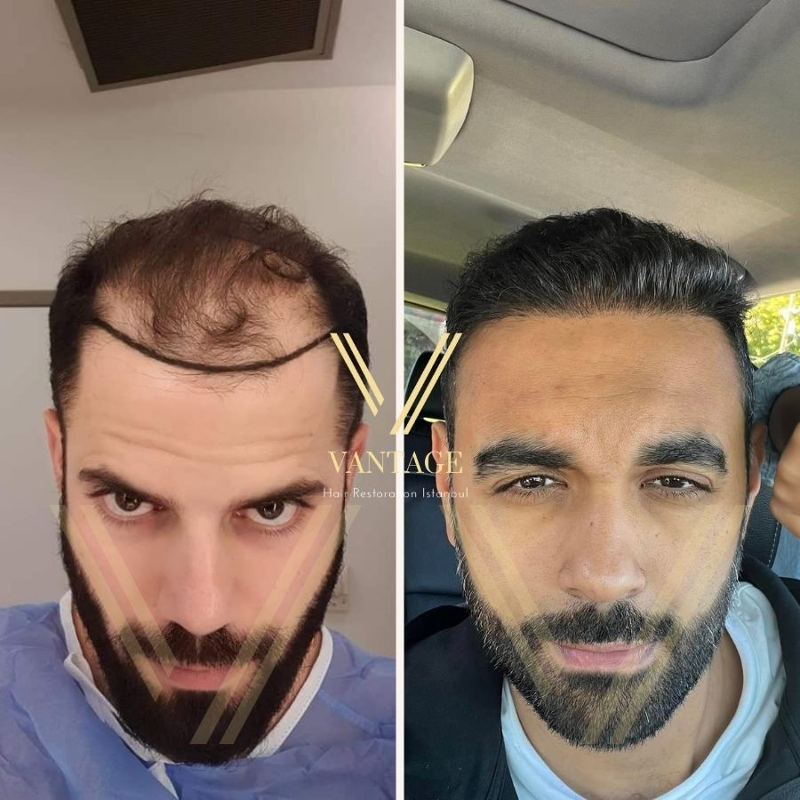 фото до и после Пересадка 5000 графтов волос Турции