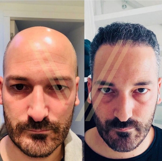 фото до и после Пересадка 5000 графтов волос в Турции