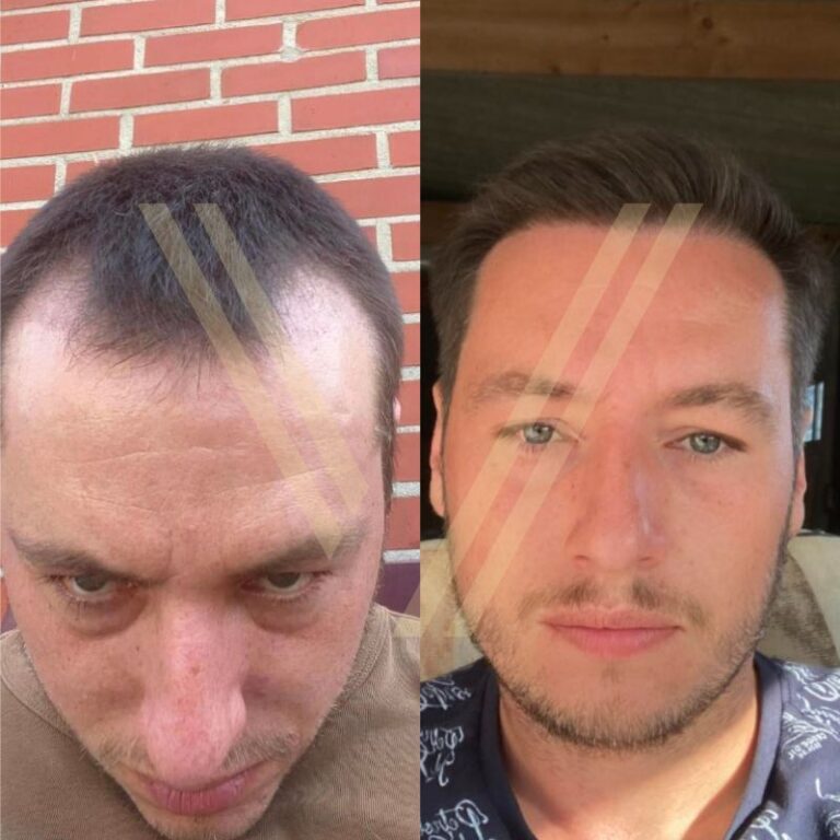 Фото до и после - 3000 графтов (пересадка волос методом FUE)