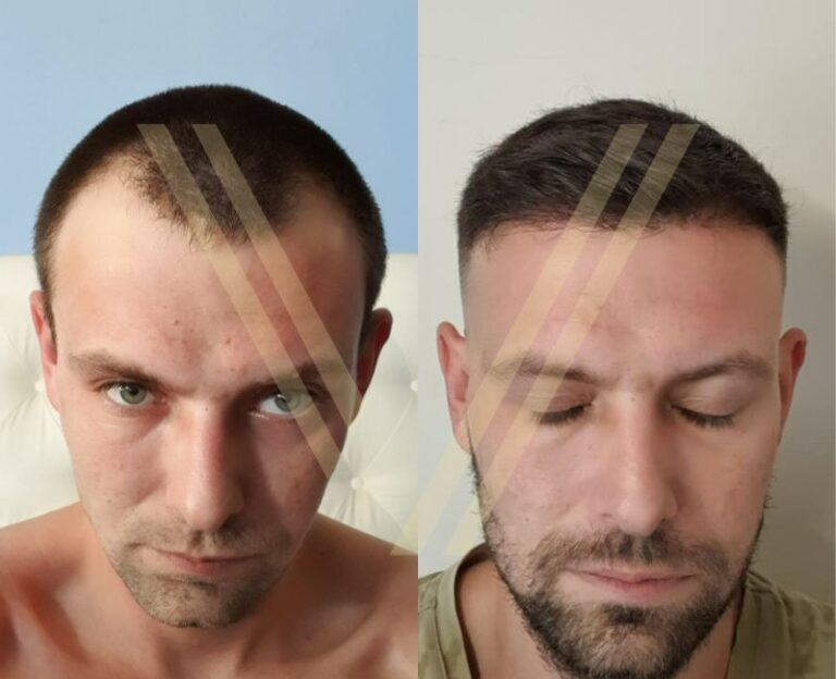 Фото до и после - 3400 графтов (пересадка волос методом FUE)