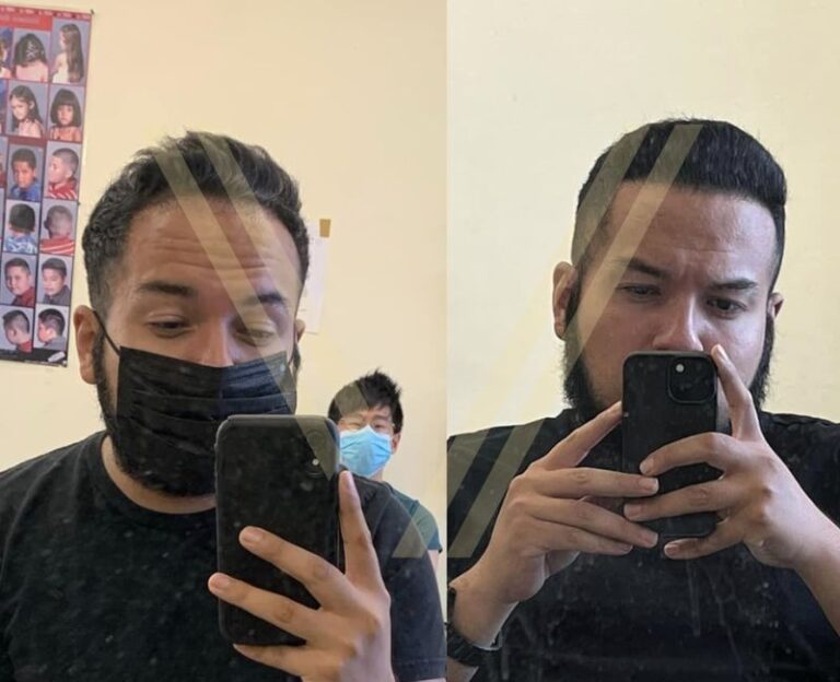 Фото до и после - 3400 графтов (пересадка волос методом FUE)