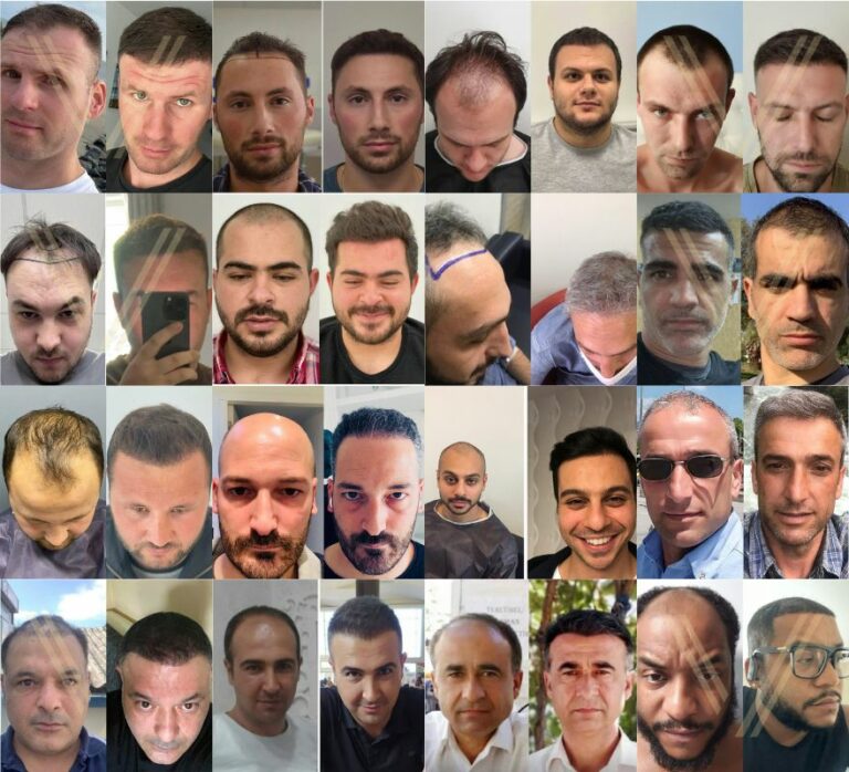Фотографии до и после пересадки волос в Турции