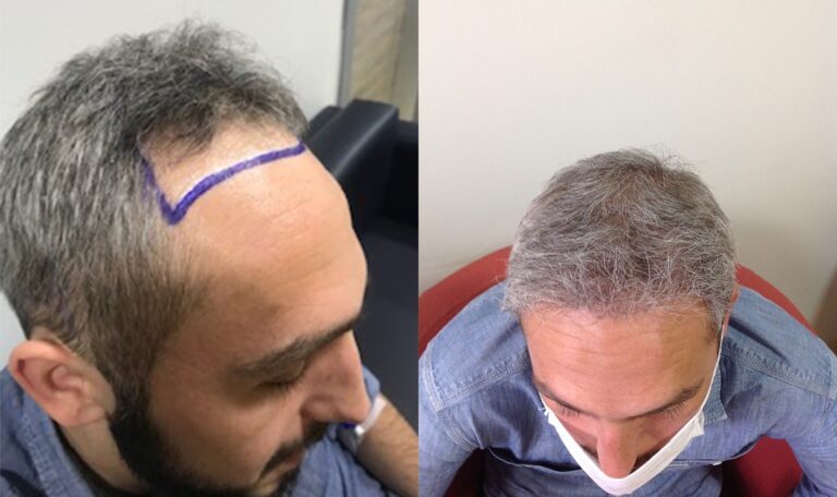 4200 greft saç ekimi öncesi ve sonrası sonucu