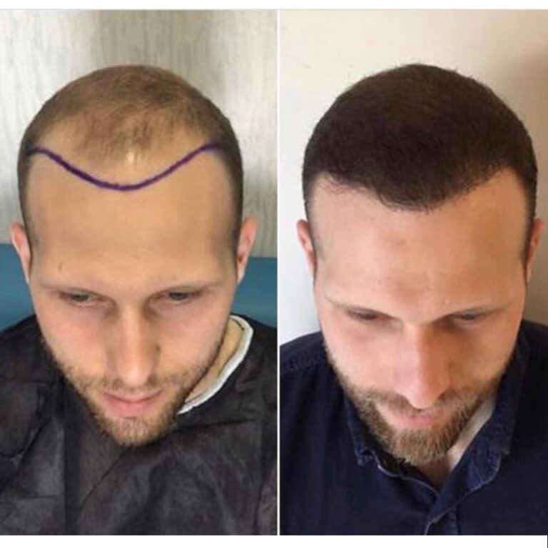 4400 saç ekimi öncesi ve sonrası erkek hasta