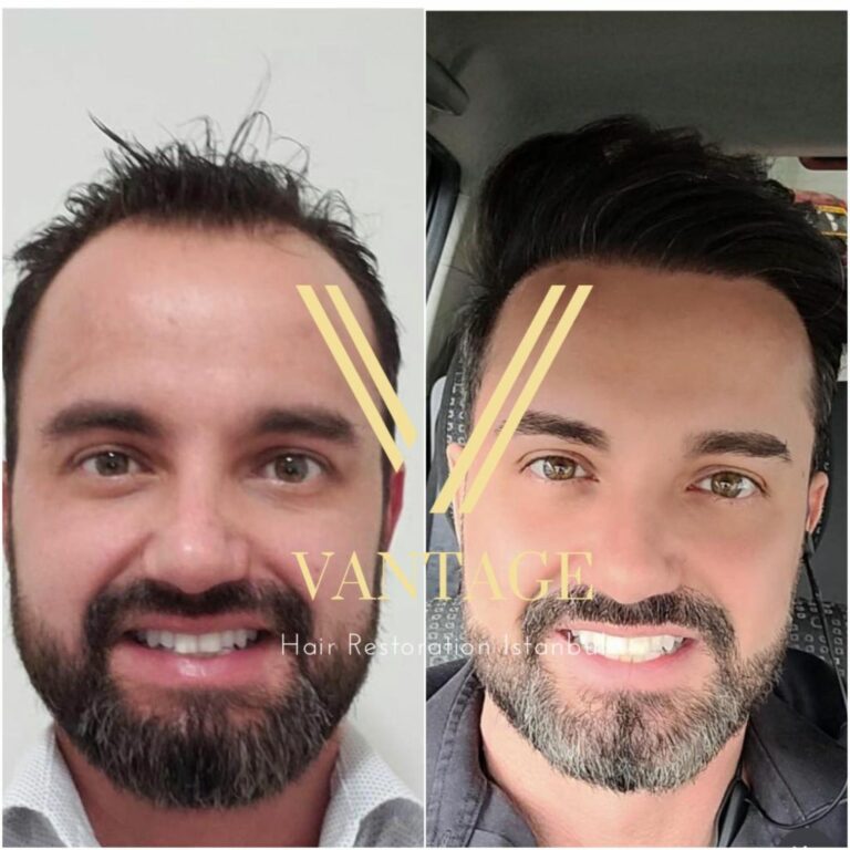4600 greft saç ekimi öncesi ve sonrası erkek