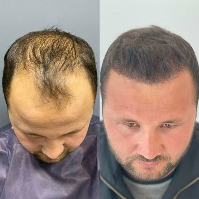 5000 greft saç ekimi fue yöntemi öncesi ve sonrası erkek