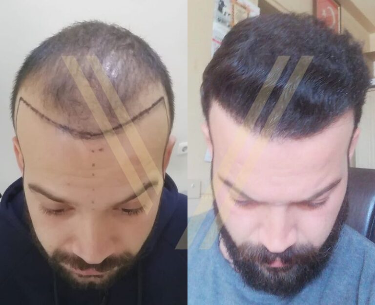 5000 greft saç ekimi öncesi sonrası erkek hasta