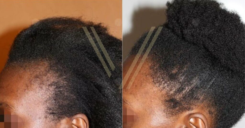 afro saç ekimi öncesi ve sonrası kadın hasta