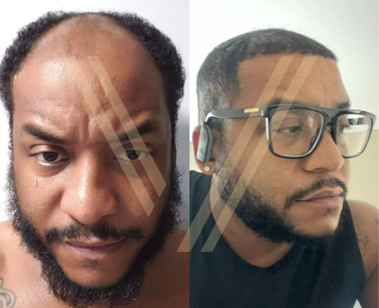 afro saç ekimi öncesi ve sonrası erkek hasta