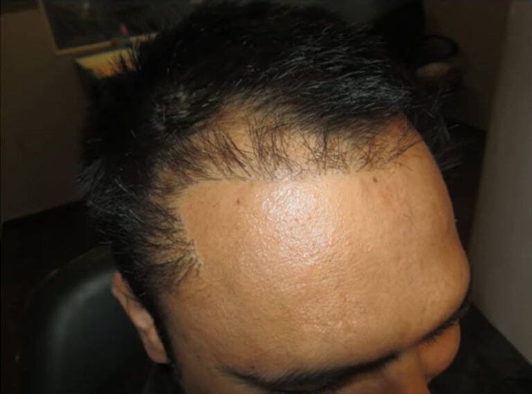 başarısız saç ekimi sonucu erkek hasta