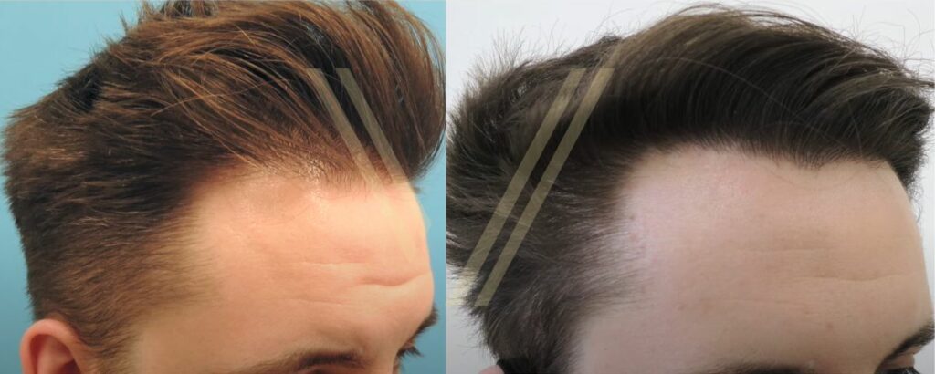 ikinci saç ekimi öncesi ve sonrası