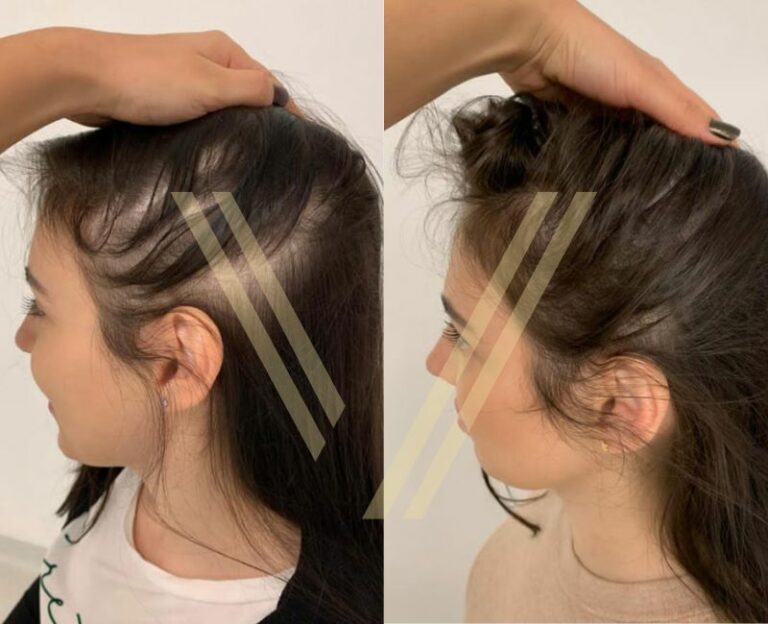 kadın saç ekimi öncesi ve sonrası