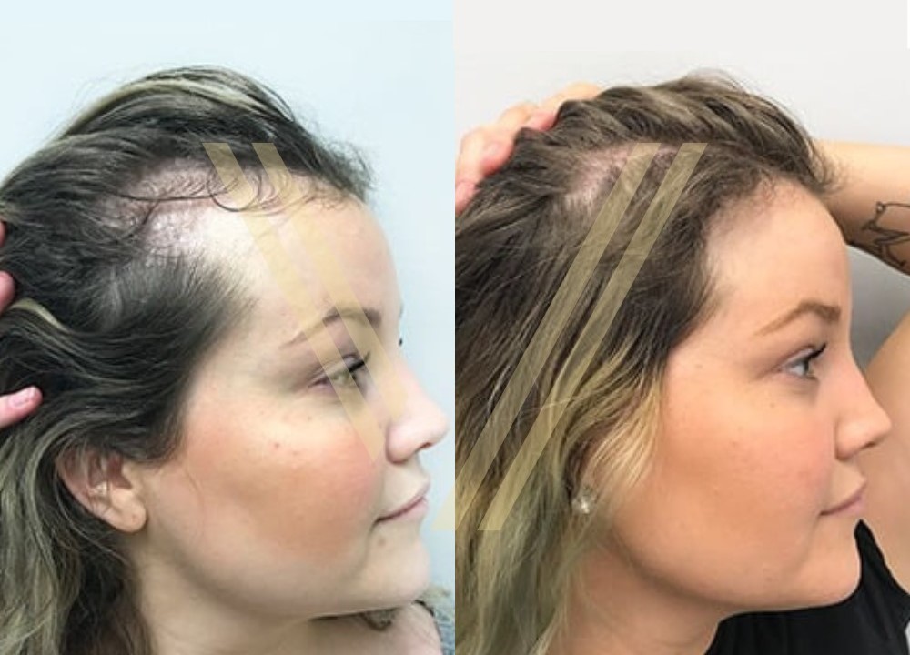 kadın tıraşsız saç ekimi öncesi ve sonrası