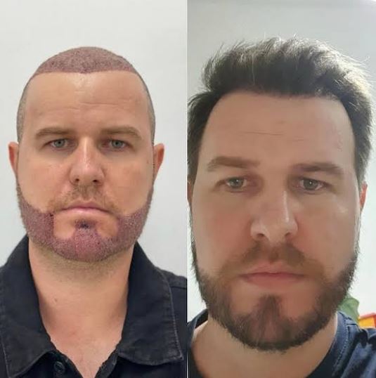 saç ve sakal ekimi öncesi ve sonrası