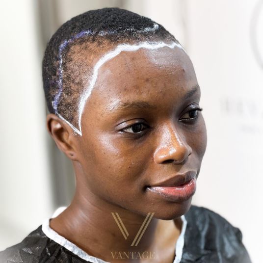 afro kadın saç çizgisi ekimi