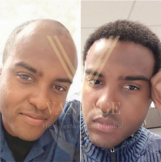 afro saç ekimi öncesi ve sonrası