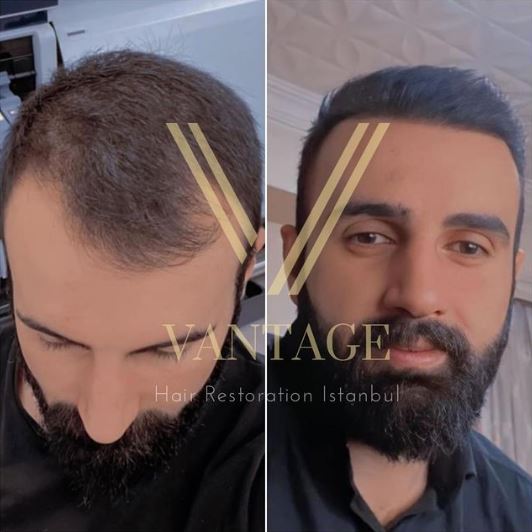 erkek saç ekimi öncesi ve sonrası