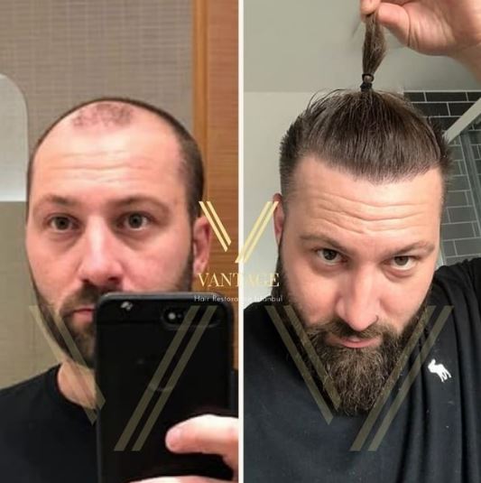 uzun saç saç ekimi öncesi ve sonrası