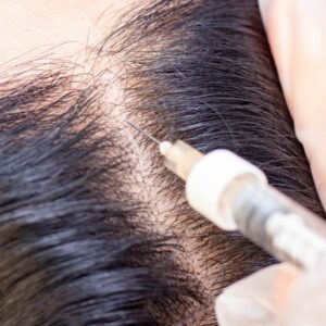 prp saç dökülmesi tedavisi kadın