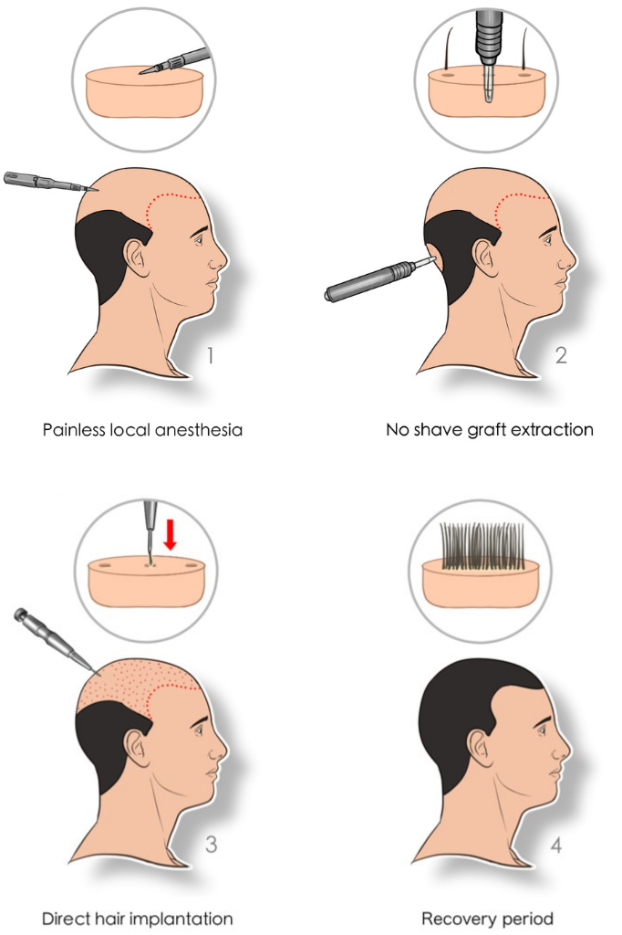 DHI hair transplant procedure steps