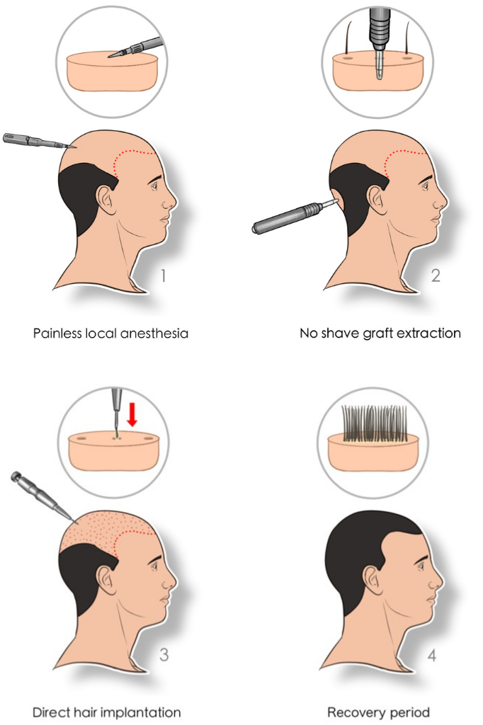 How Does DHI Hair Transplant Work?