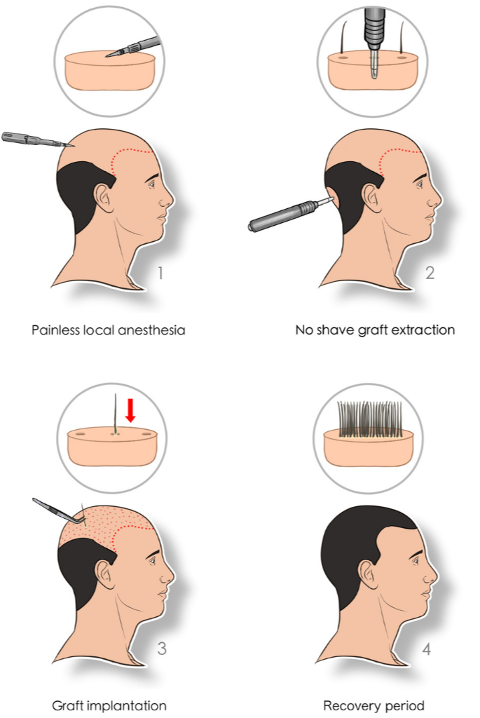 how do hair transplants work