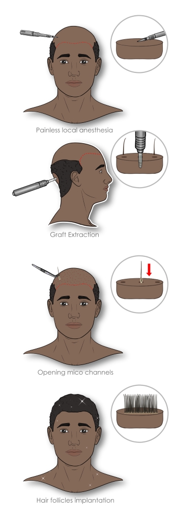 afro hair transplant procedure steps