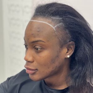 female afro hair transplant in istanbul