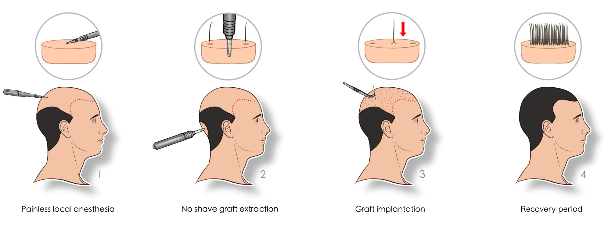 hair transplant process 4 main steps