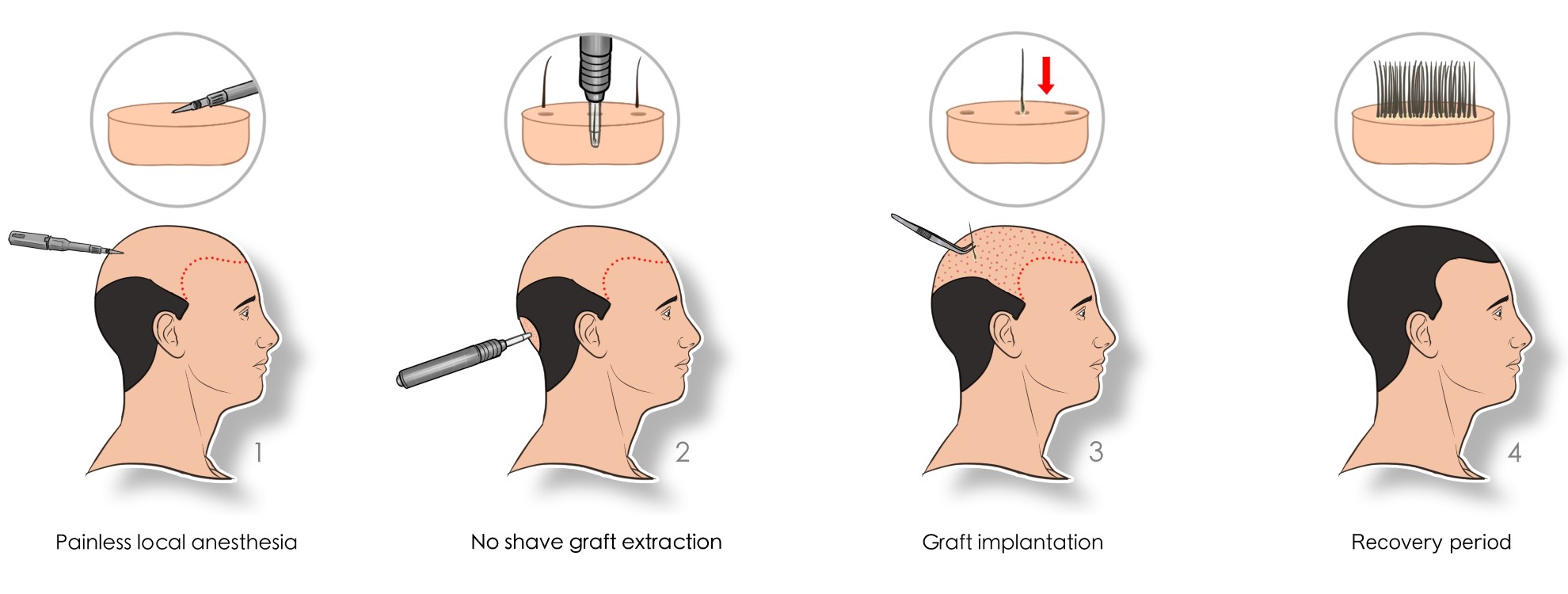 5000 Grafts Hair Transplant in Turkey 2024 Costs Vantage Clinic