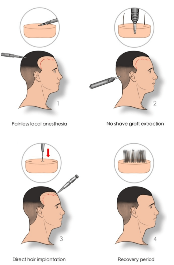 Hair Transplant Without Shaving in Istanbul | Updated Prices (2022)
