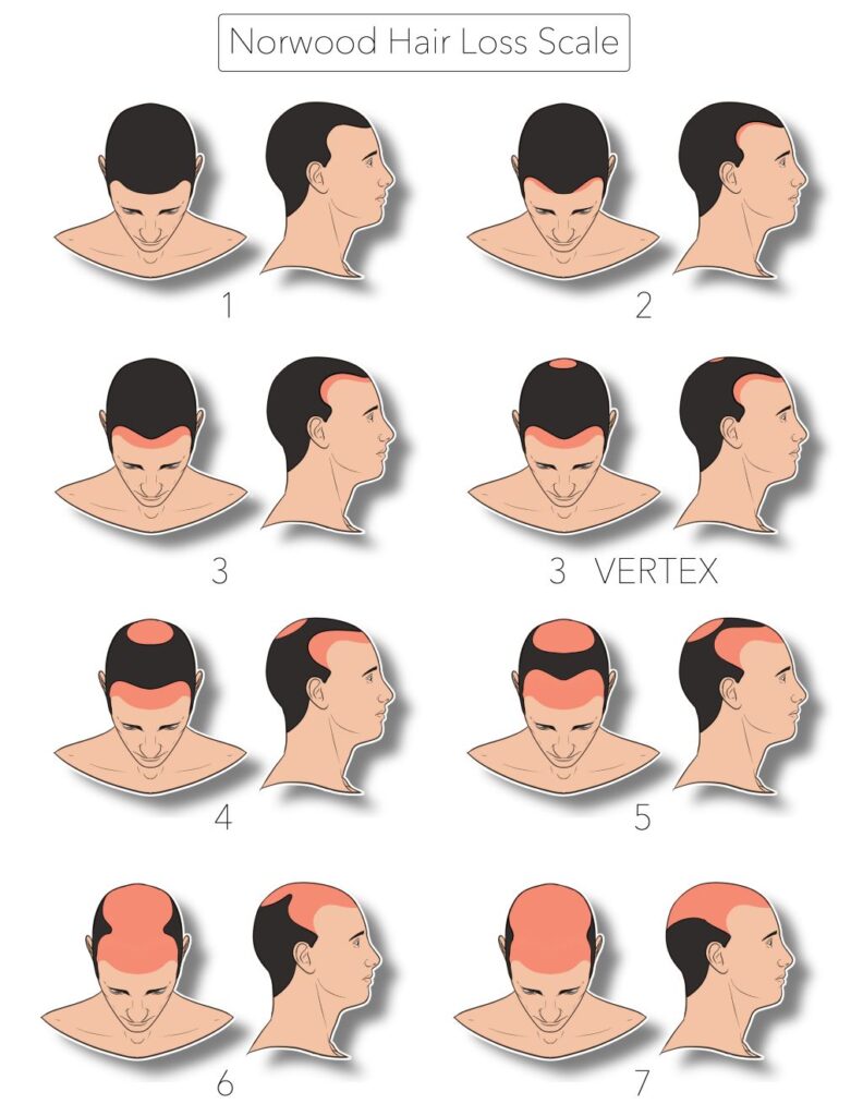 norwood hair loss scale