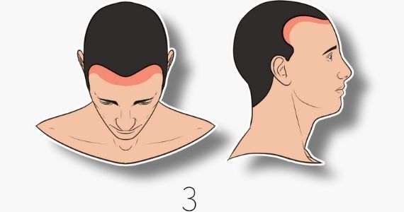 type 3 norwood hair loss scale