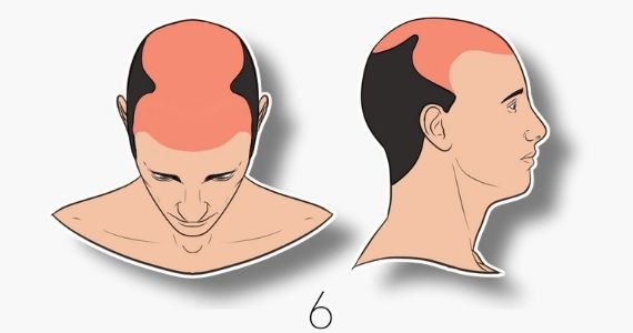 type 6 norwood hair loss scale