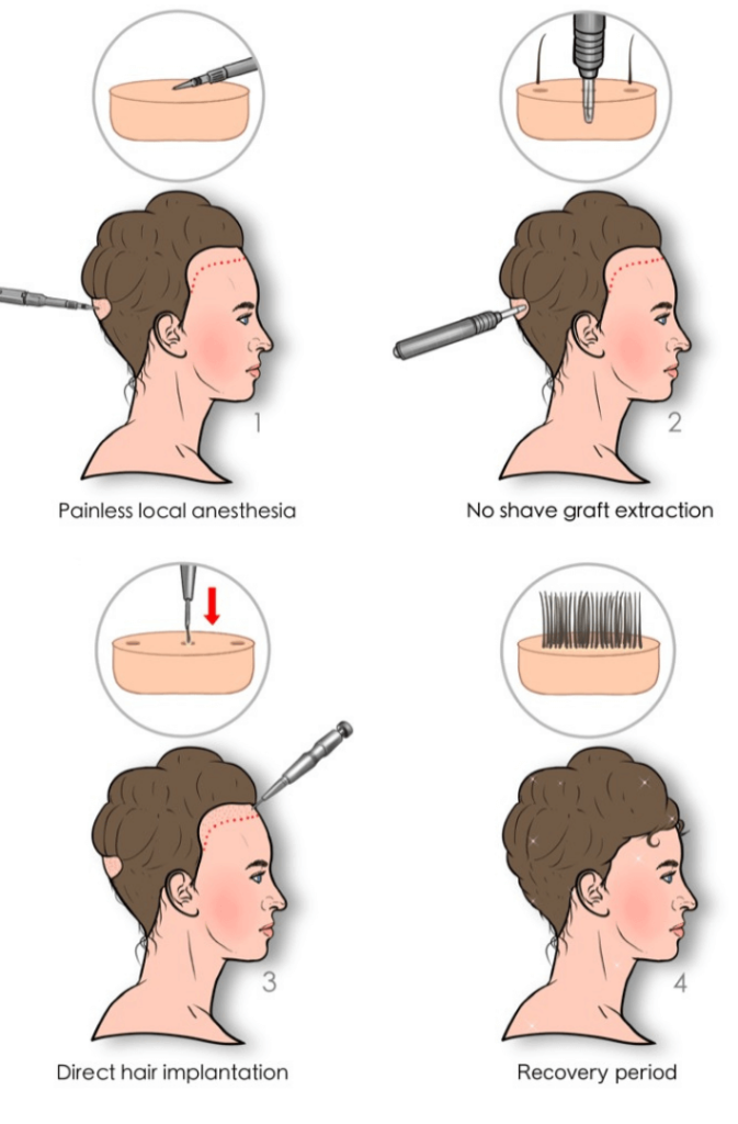 unshaven female hair transplant process steps