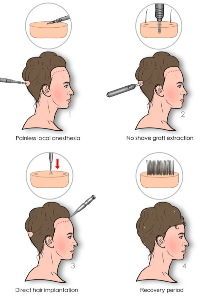 unshaven female hair - long hair fue hair transplant process steps