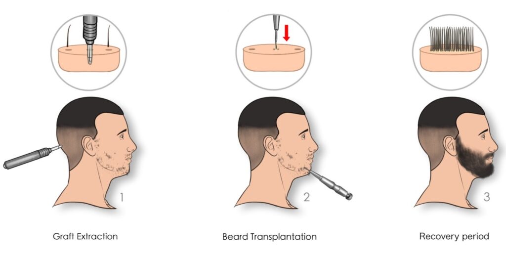 beard and moustache transplant process