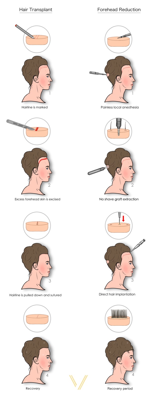 hair transplant vs forehead reduction for hairline lowering operation