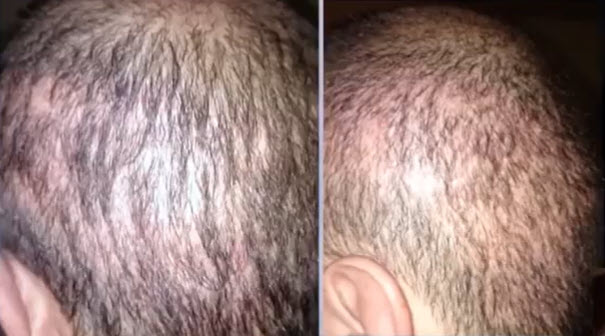 bad and ineligible hair transplant candidate due to lack of donor area