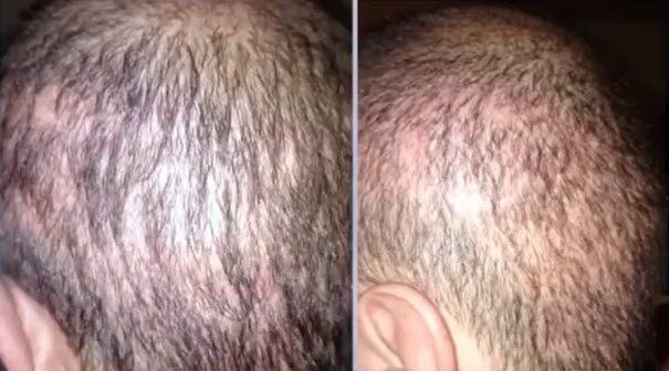 Best Correction of Previous Bad Hair Transplant Cost  Surgery  Clinic