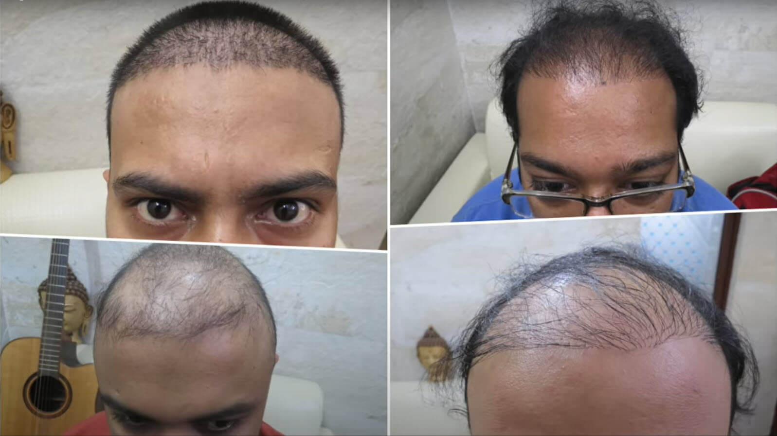 Repair a Bad Hair transplant