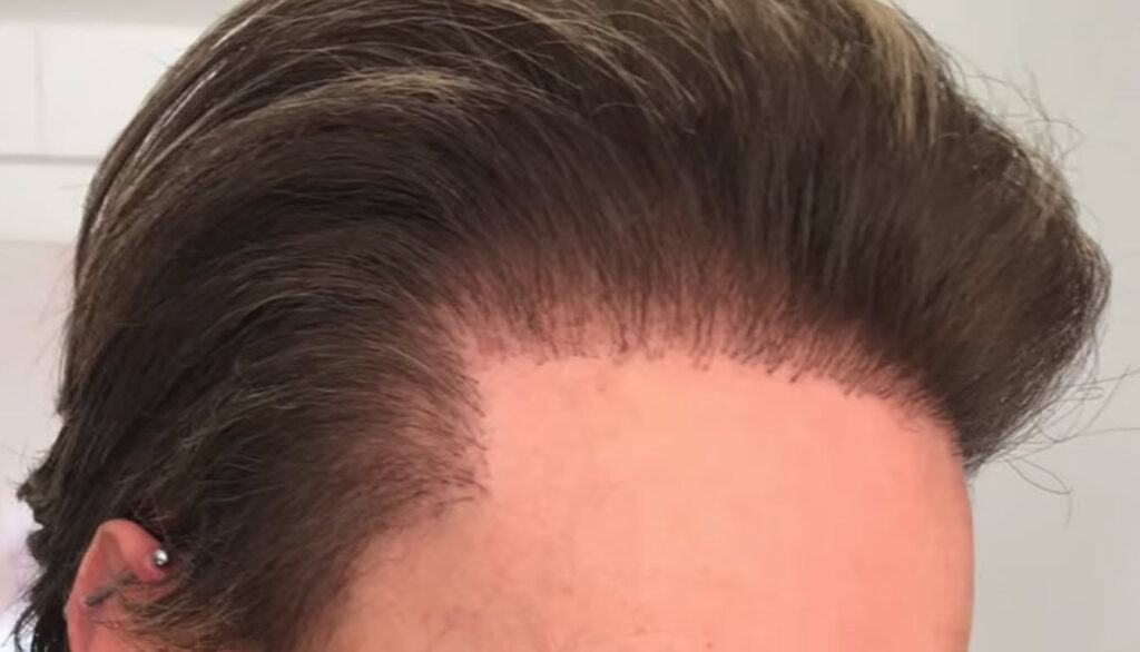 inexperienced clinic hair transplant