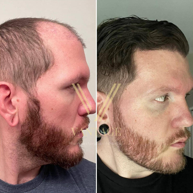 Hair Transplant Before And After 5000 Grafts