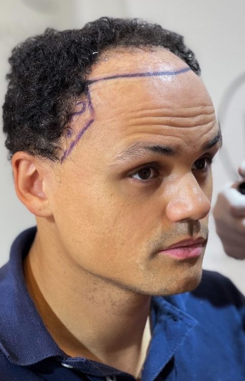 hiv hair transplant patient curly hair