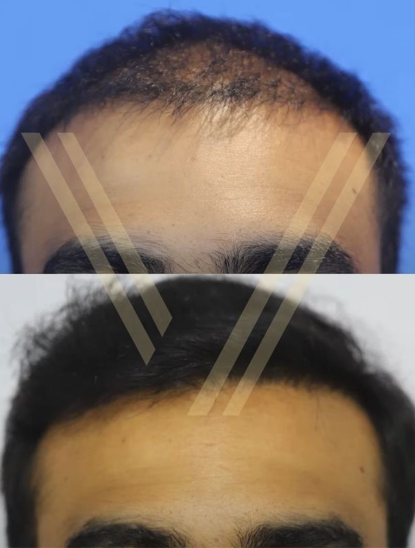 2000 graft hair transplant frontline result photo