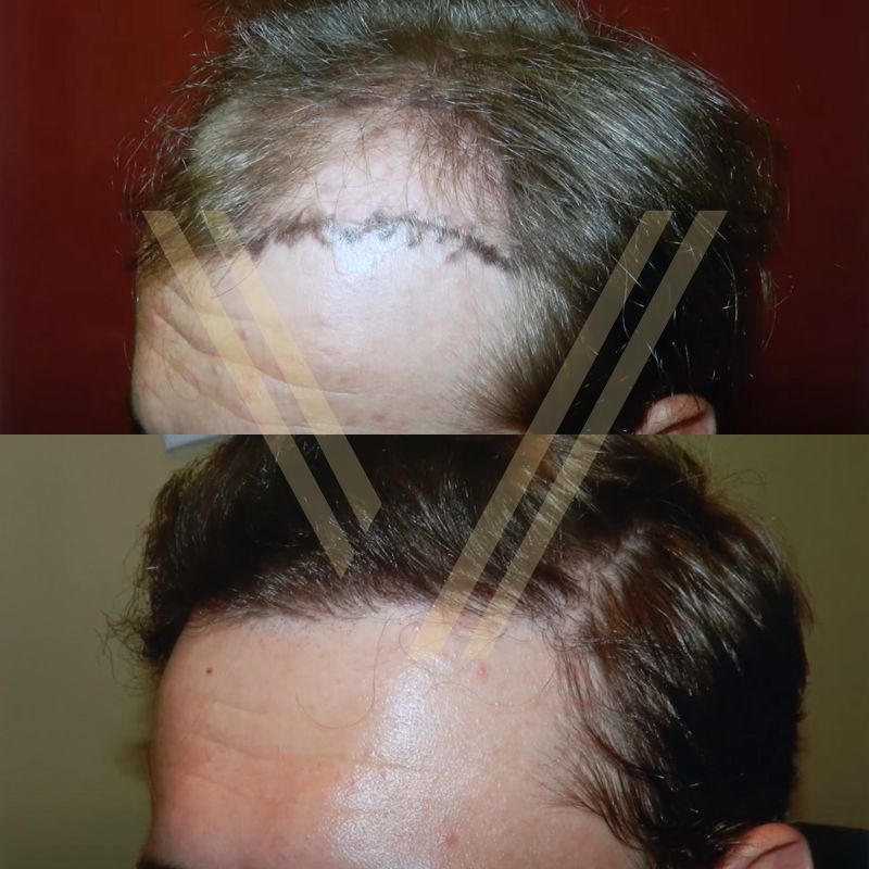 How Much Does 1000 Grafts Hair Transplant Cost In Turkey