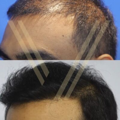 2000 graft hair transplant operation before and after