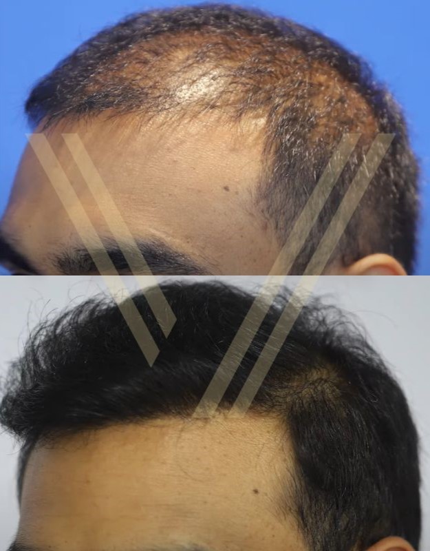 2000 graft hair transplant operation before and after